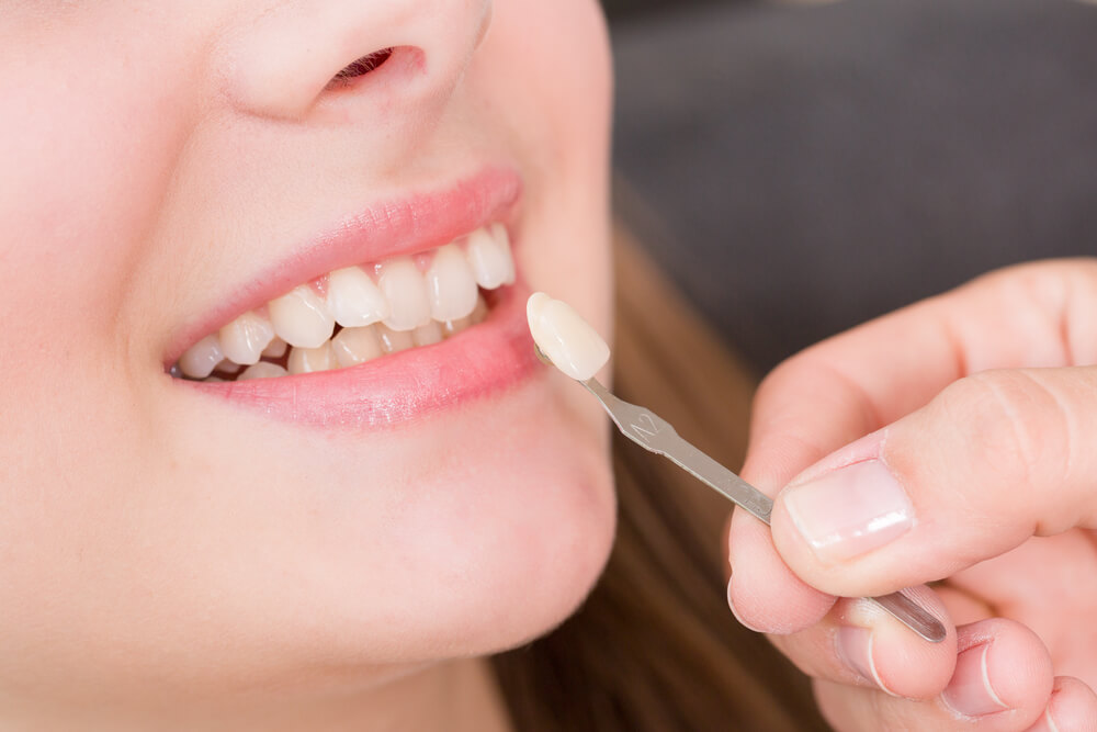 Dentist placing a dental veneer between teeth